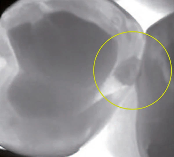 Near-infrared DIAGNOcam view showing a dark caries lesion between adjacent teeth