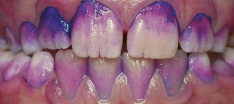 Teeth under normal light showing pink and blue plaque staining representative of Curaprox Plaquefinder
